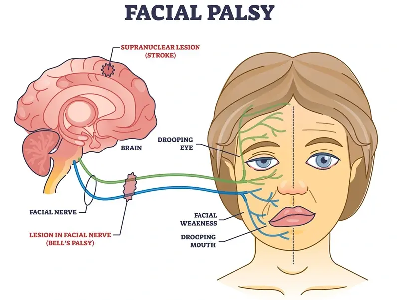 Facial palsy treatment