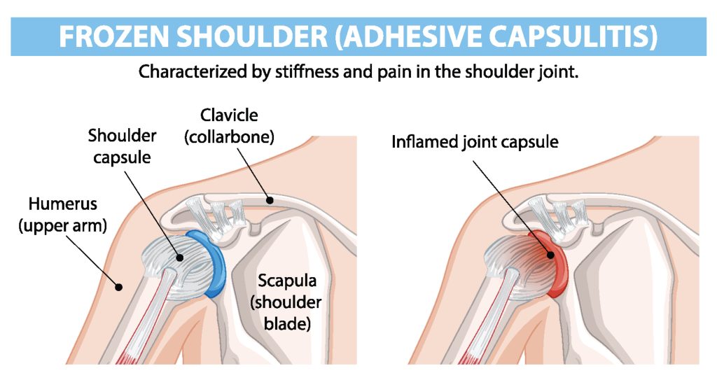 Frozen shoulder treatment Jaipur