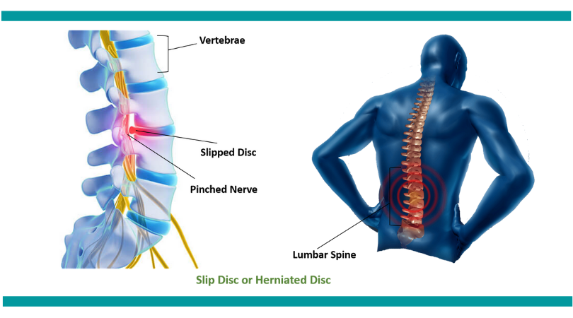 Slip disc treatment in Jaipur