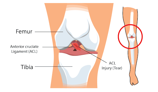 ACL injury specialist Raja Park
