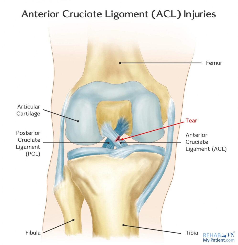 ACL reconstruction rehab Raja Park Jaipur