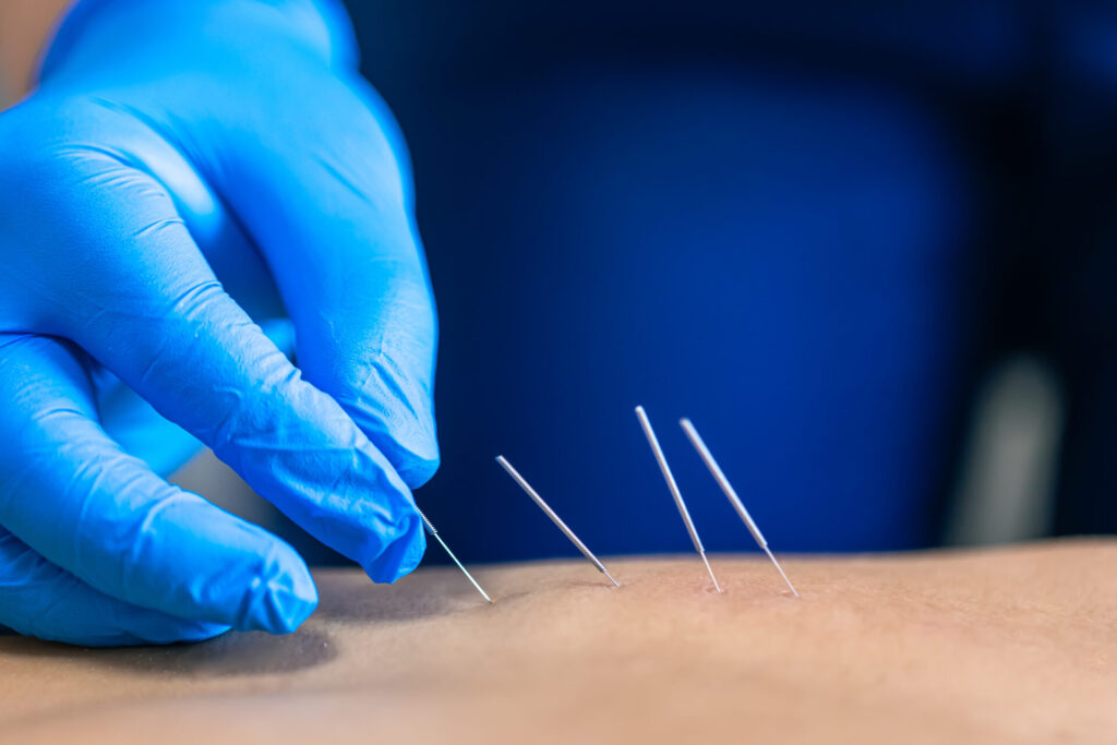 Dry needling in Jaipur