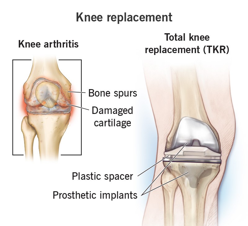 Knee replacement rehab
