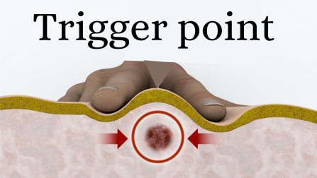Dry needling specialist in Tilak Nagar Jaipur