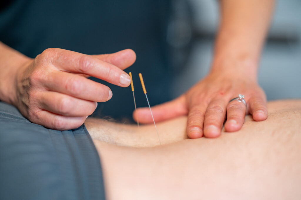 Dry needling specialist in Tilak Nagar Jaipur