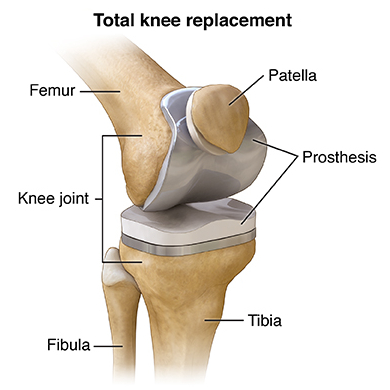 Post-operative TKR recovery Tilak Nagar