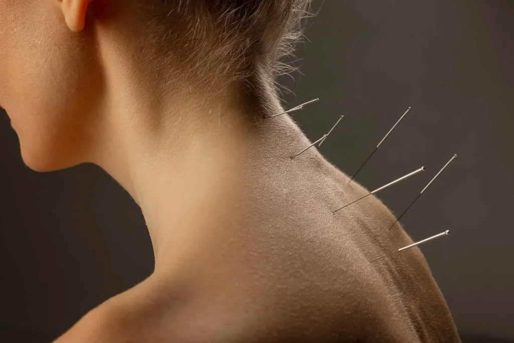 Dry needling for neck pain Jaipur East