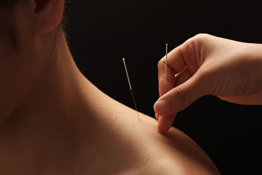 Dry needling for neck pain Jaipur East