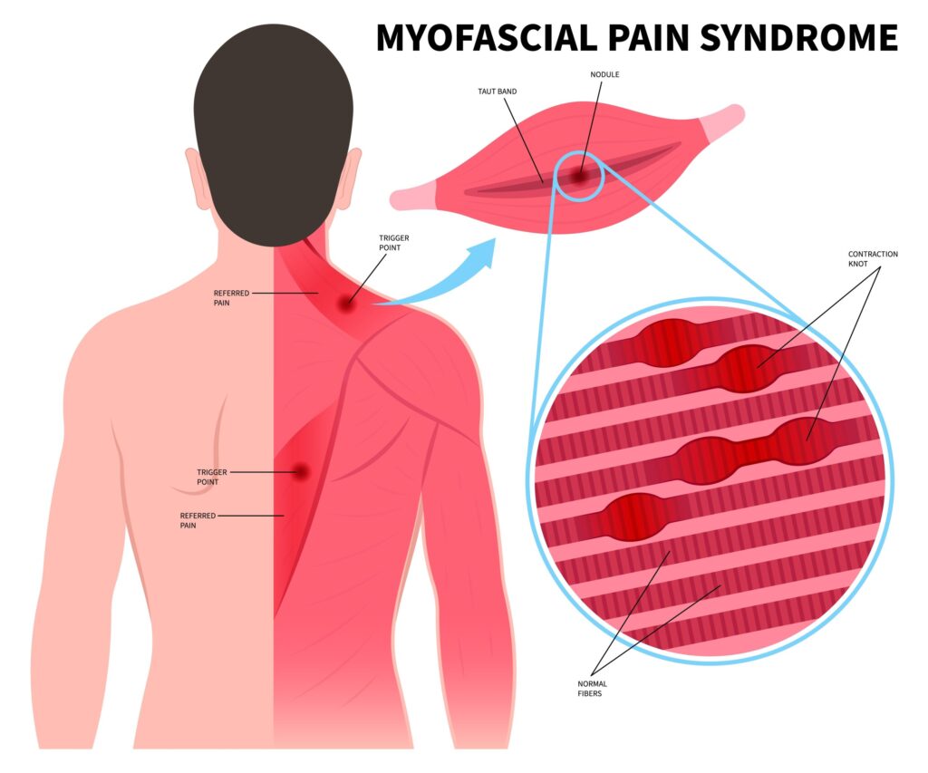 Myofascial Pain Syndrome specialist Raja Park