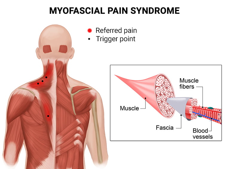 Myofascial Pain Syndrome specialist Raja Park