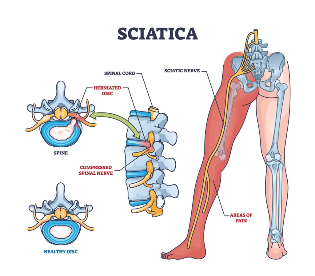 Sciatica pain specialist Jawahar Nagar